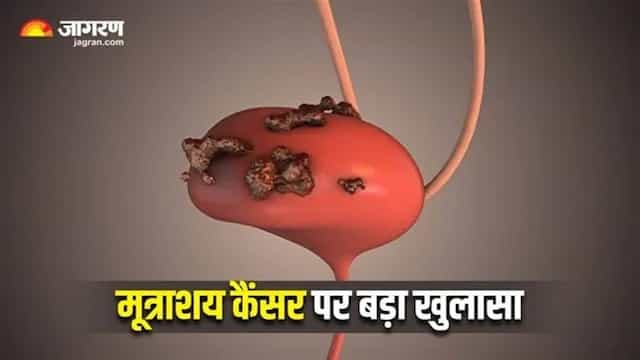 ਸਰਜਰੀ ਤੋਂ ਬਾਅਦ ਰੇਡੀਏਸ਼ਨ ਥੈਰੇਪੀ ਨਾਲ ਅੱਧਾ ਹੋ ਜਾਂਦਾ ਹੈ Bladder Cancer ਦਾ ਖ਼ਤਰਾ, ਨਵੀਂ ਖੋਜ ਨੇ ਜਗਾਈ ਉਮੀਦ